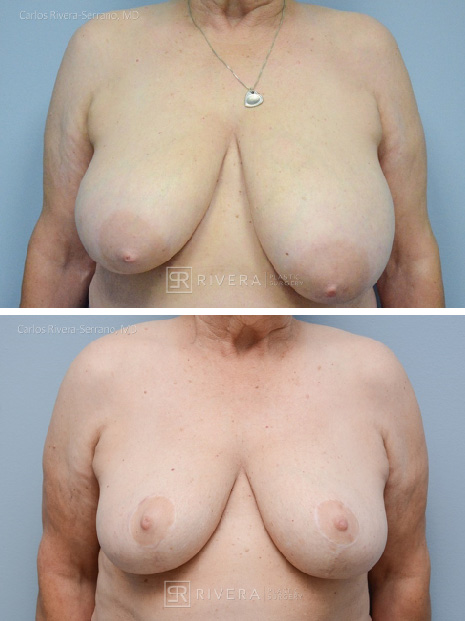 potrait breastreduction case18 dr carlos rivera serrano