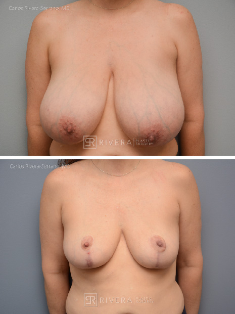 potrait breastreduction case22 dr carlos rivera serrano