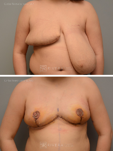 potrait breastreduction case23 dr carlos rivera serrano