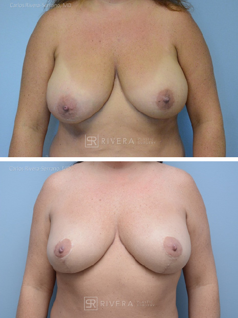 potrait breastreduction case5 dr carlos rivera serrano
