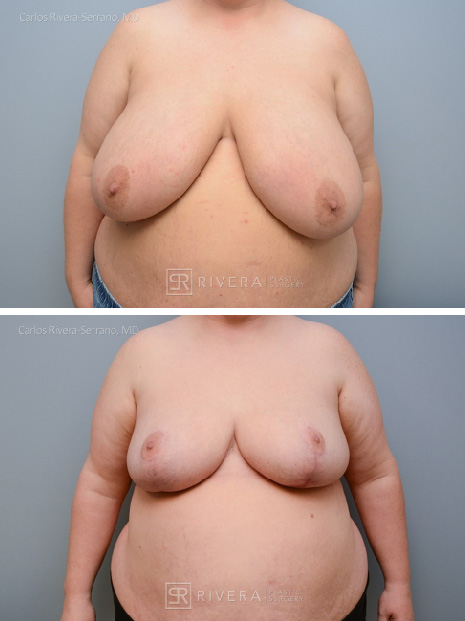 potrait breastreduction case6 dr carlos rivera serrano
