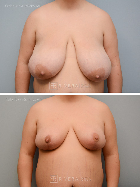 potrait breastreduction case8 dr carlos rivera serrano