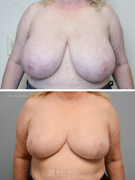 potrait breastreduction case9 dr carlos rivera serrano