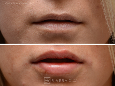 Lip Augmentation  South Florida Facial Plastic Surgery