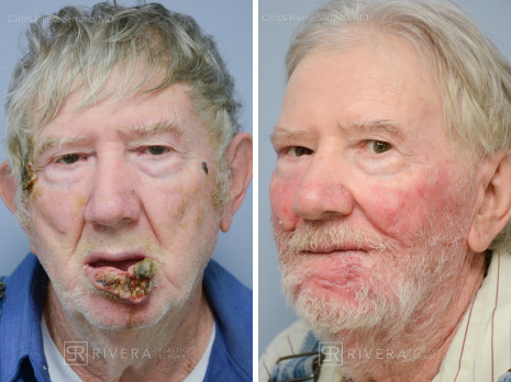 Total lower lip reconstruction from advanced lip cancer with Bernard - Webster lip reconstruction technique - Man - Case 19202 - Before and after - Frontal view