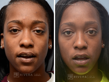 Upper lip reconstruciton with local flaps - Woman - Case 19206 - Before and after - Frontal view