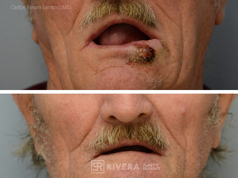 Lower lip reconstruction from skin cancer removal with local Advancement flaps - Man - Case 19208 - Before and after - Frontal view
