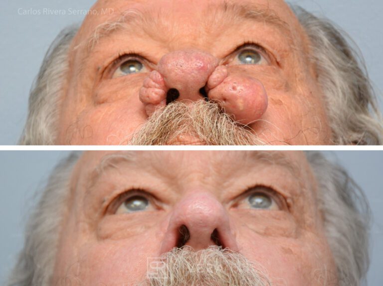 Rhinophyma correction in male patient - Nose Surgery (Rhinoplasty) - Before and after case 1 - Inferior view