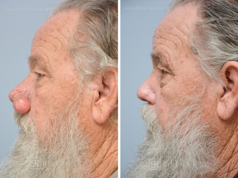 Rhinophyma correction in male patient - Nose Surgery (Rhinoplasty) - Before and after case 1 - Profile view