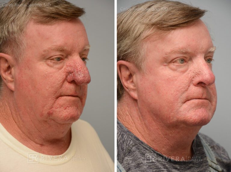 Rhinophyma correction in male patient - Nose Surgery (Rhinoplasty) - Before and after case 2 - Lateral view