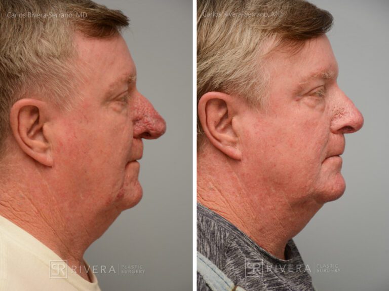 Rhinophyma correction in male patient - Nose Surgery (Rhinoplasty) - Before and after case 2 - Profile view