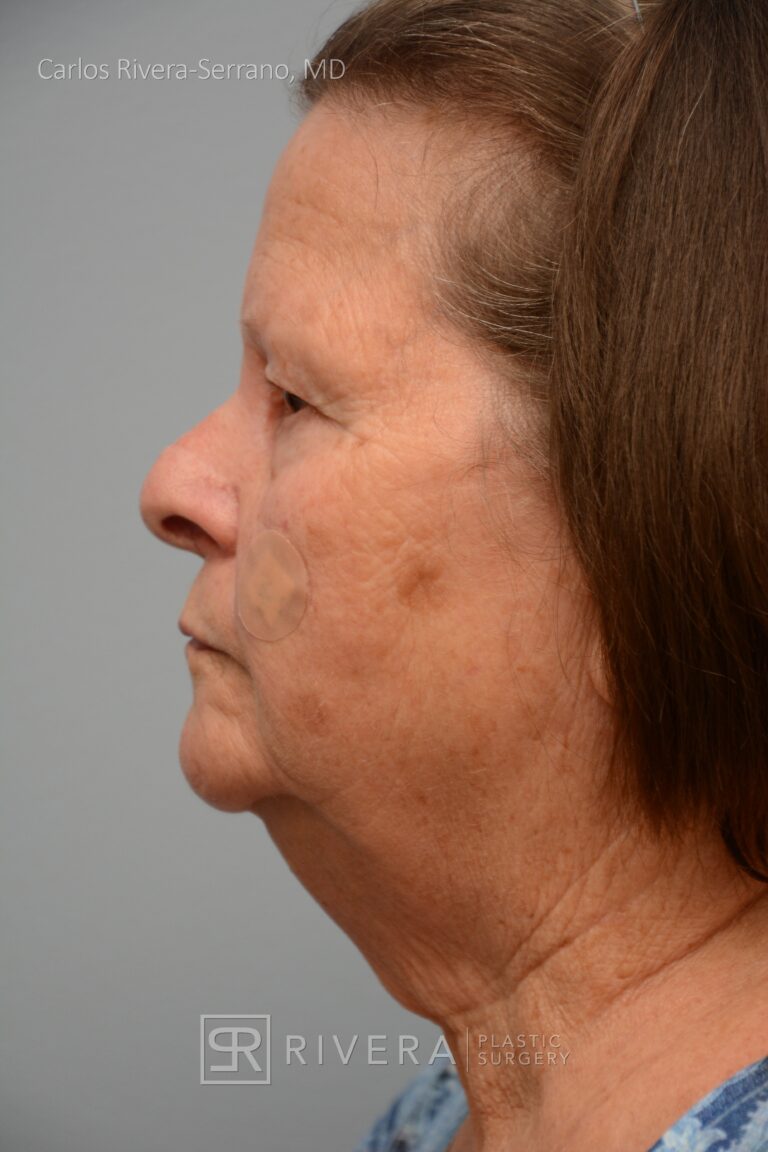 Cheek wound reconstruction from skin cancer removal with Dorsal Sliding advancement flap - Woman - Case 111217 - After surgery - Lateral view