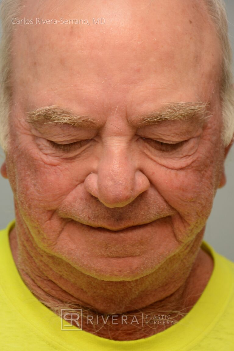 Nose reconstruction from skin cancer removal with Melolabial flap - Man - Case 16519 - Postoperative - Superior view