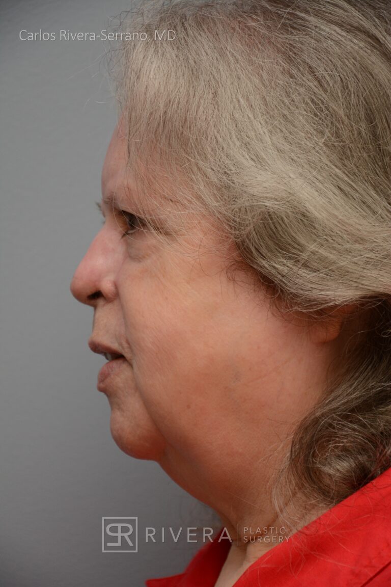 Cheek & Nose wound reconstruction from skin cancer removal with Paramedian forehead flap & cheek advacement flap - Woman - Case 11126 - After surgery - Lateral view