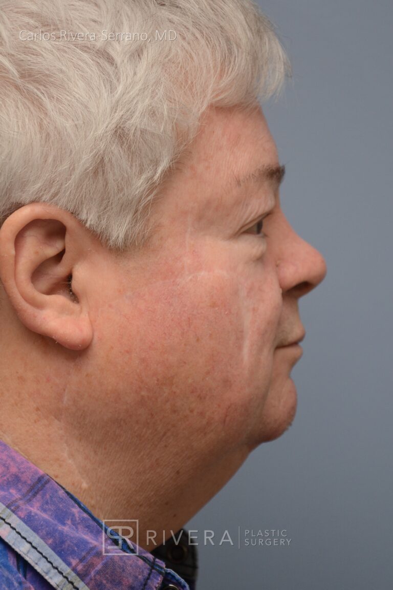 Cheek wound reconstruction from skin cancer removal with Cervicofacial flap - Man - Case 111214 - After surgery - Lateral view