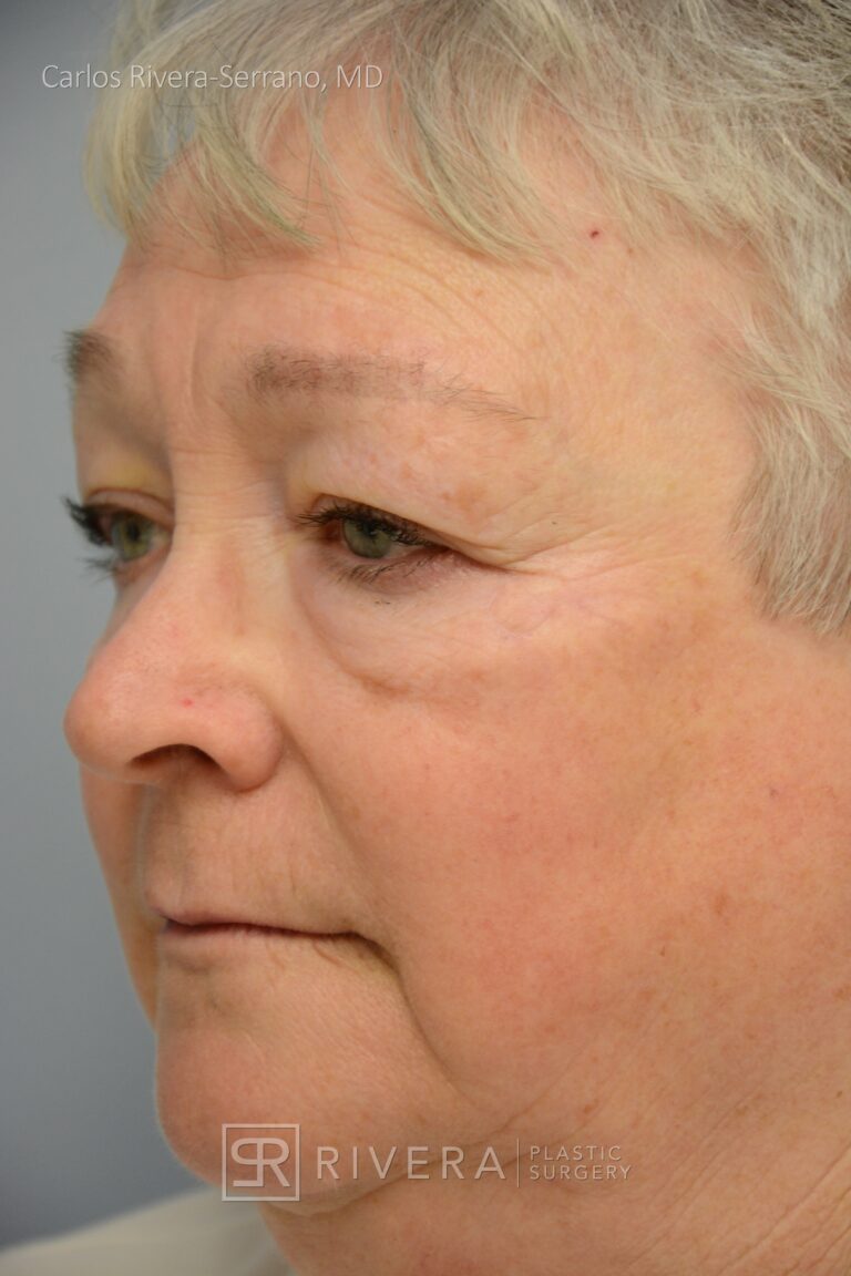 Eyelid & Periocular Reconstruction in female patient – Eyelid & Brow Surgery – Skin cancer – after case 12 – Lateral view