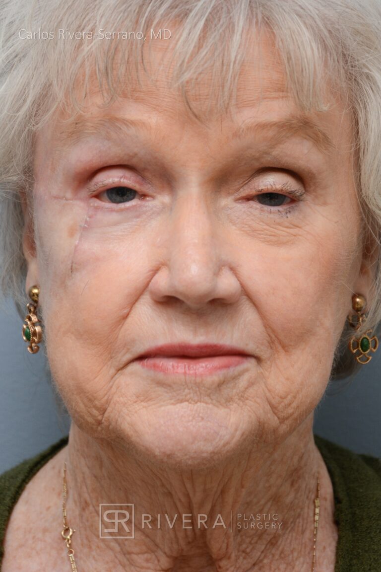 Cheek - lower eyelid wound reconstruction from skin cancer removal with Burow's Triangle Displacement Flap - Woman - Case 11129 - After surgery - Frontal view