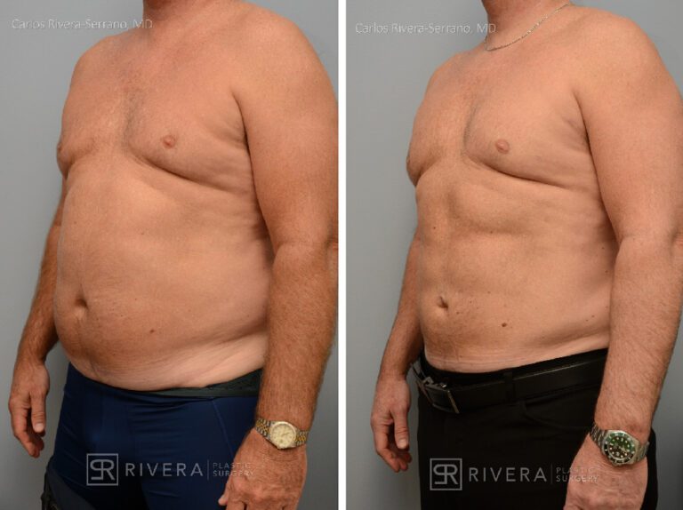 Abdominoplasty & liposuction in male patient - Tummy tuck lipoabdominoplasty - before and after case 1 - left lateral view