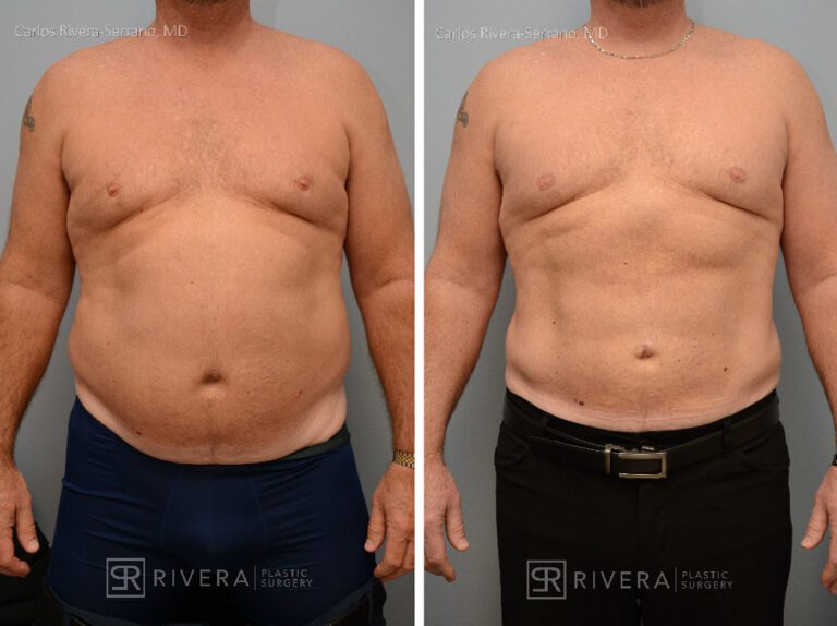 Abdominoplasty & liposuction in male patient - Tummy tuck lipoabdominoplasty - before and after case 1 - frontal view