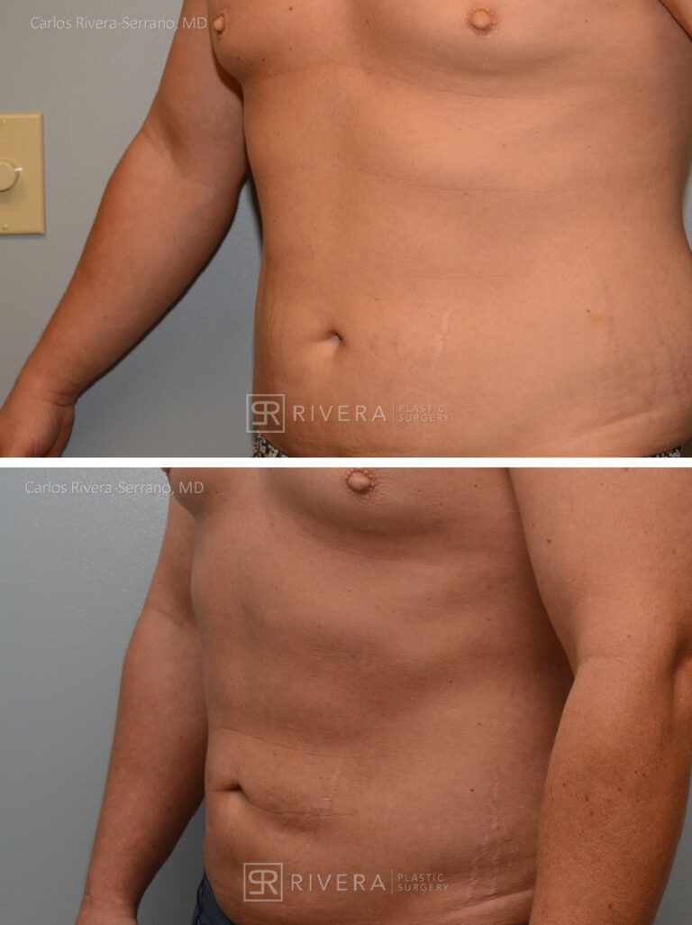 Abdominoplasty & liposuction in male patient - Tummy tuck lipoabdominoplasty - before and after case 2 - left lateral view