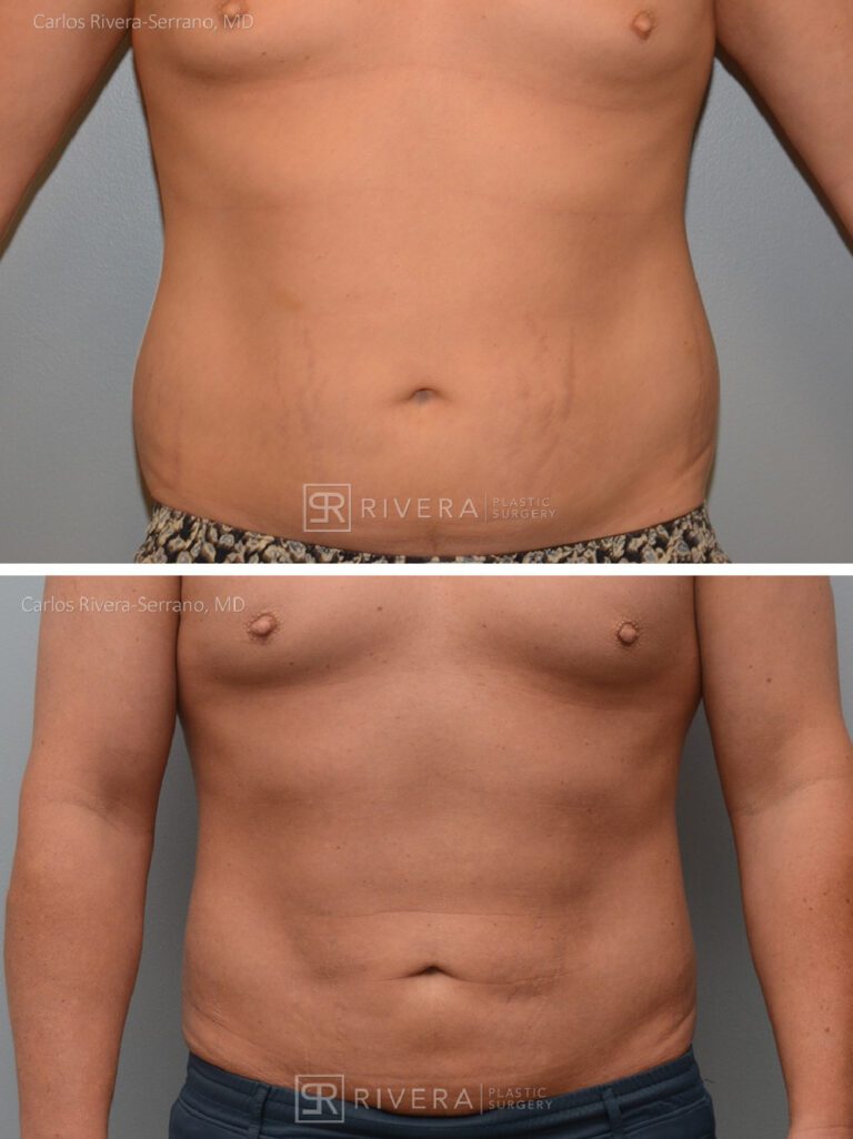 Abdominoplasty & liposuction in male patient - Tummy tuck lipoabdominoplasty - before and after case 2 - frontal view