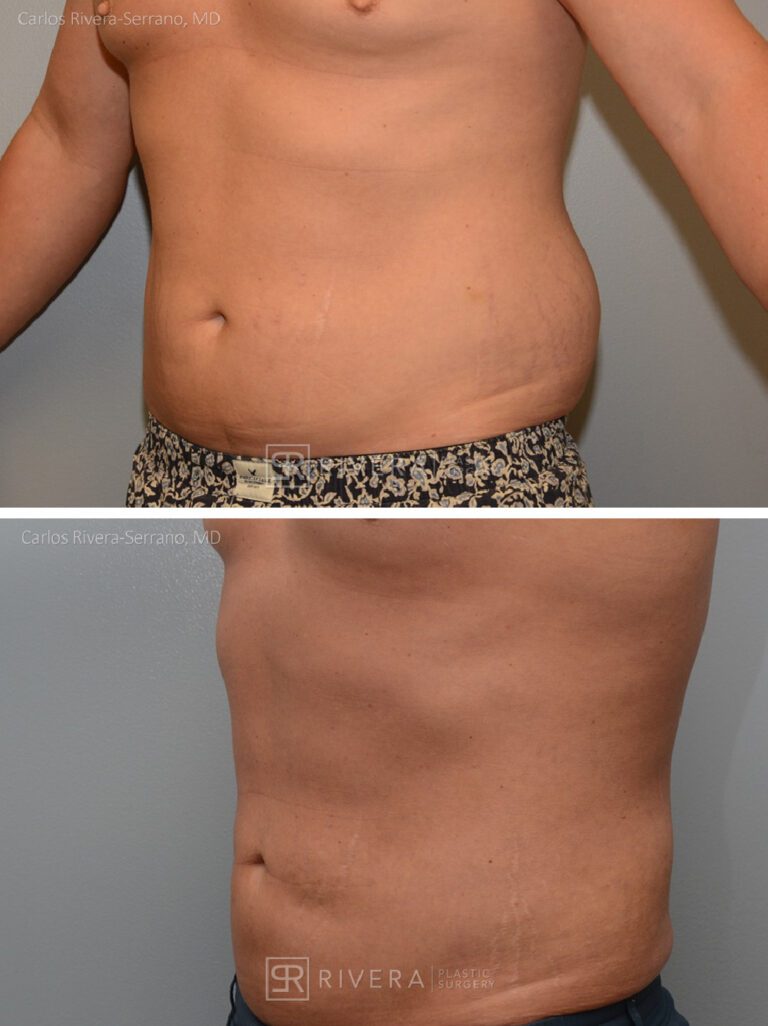 Abdominoplasty & liposuction in male patient - Tummy tuck lipoabdominoplasty - before and after case 2 - left lateral view