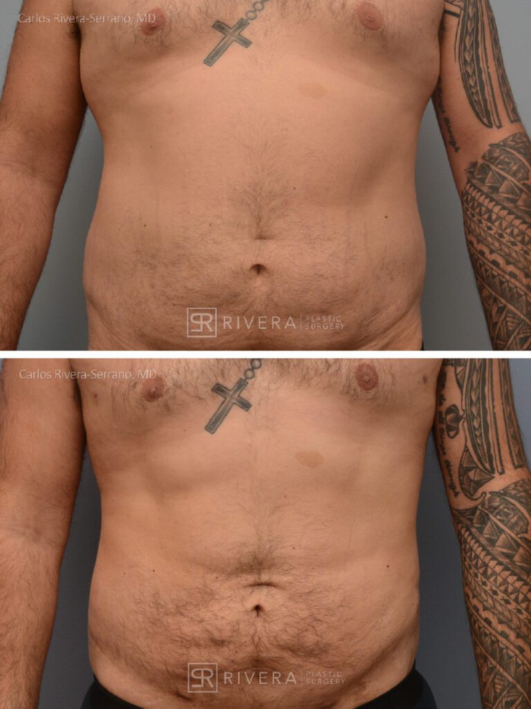 Abdominoplasty & liposuction in male patient - Tummy tuck lipoabdominoplasty - before and after case 3 - frontal view