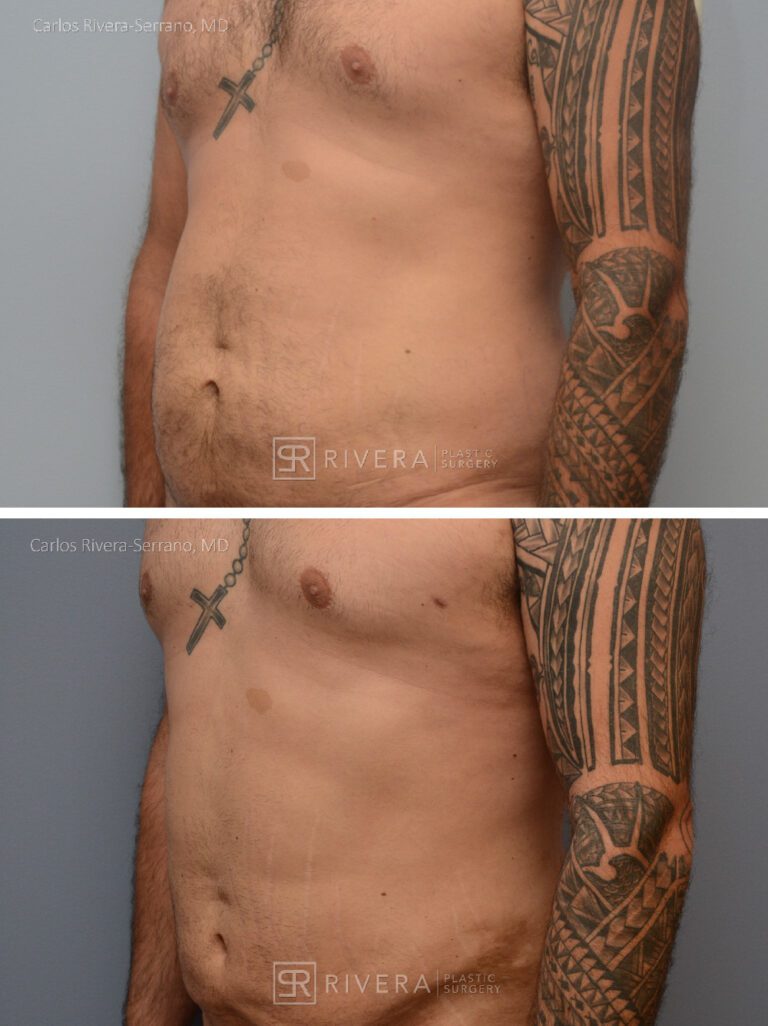 Abdominoplasty & liposuction in male patient - Tummy tuck lipoabdominoplasty - before and after case 3 - left lateral view
