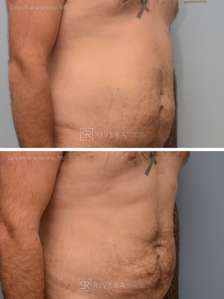Abdominoplasty & liposuction in male patient - Tummy tuck lipoabdominoplasty - before and after case 3 - right lateral view
