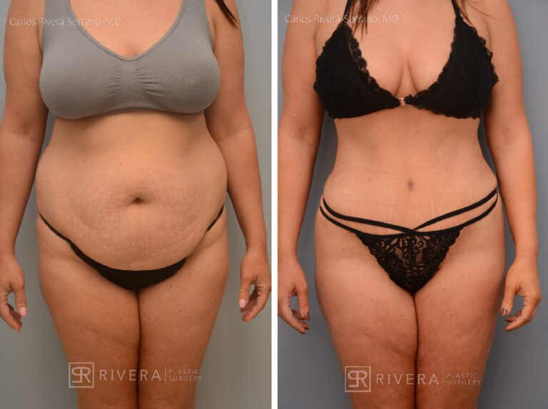 Abdominoplasty & liposuction in female patient - Tummy tuck lipoabdominoplasty - before and after case 2 - frontal view