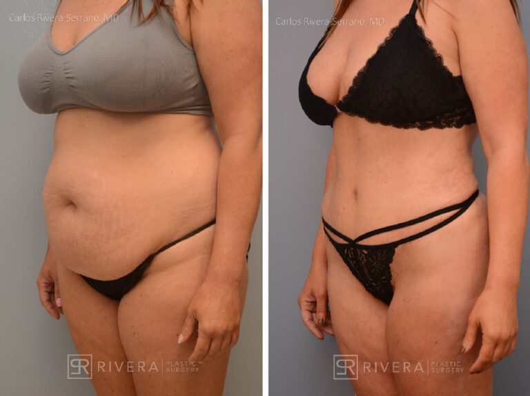 Abdominoplasty & liposuction in female patient - Tummy tuck lipoabdominoplasty - before and after case 2 - left lateral view