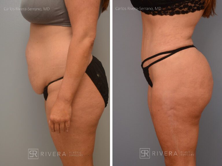 Abdominoplasty & liposuction in female patient - Tummy tuck lipoabdominoplasty - before and after case 2 - left lateral view