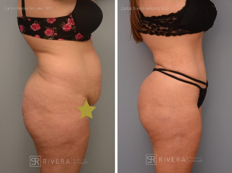 Abdominoplasty & liposuction in female patient - Tummy tuck lipoabdominoplasty - before and after case 2 - right lateral view