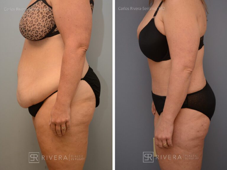 Abdominoplasty & liposuction in female patient - Tummy tuck lipoabdominoplasty - before and after case 3 - left lateral view
