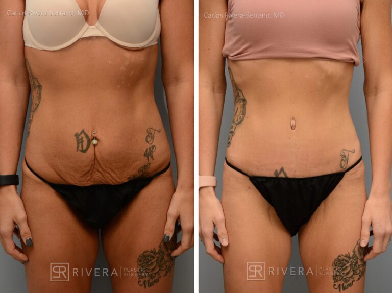 Abdominoplasty & liposuction in female patient - Tummy tuck lipoabdominoplasty - before and after case 4 - frontal view