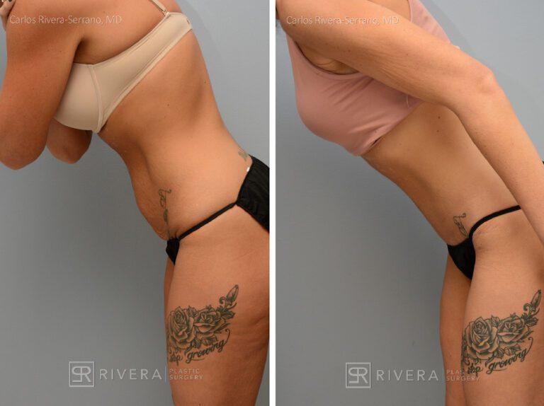 Abdominoplasty & liposuction in female patient - Tummy tuck lipoabdominoplasty - before and after case 4 - left lateral view