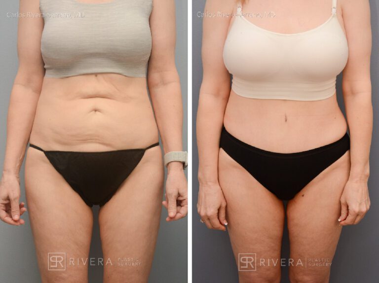 Abdominoplasty & liposuction in female patient - Tummy tuck lipoabdominoplasty - before and after case 5 - frontal view