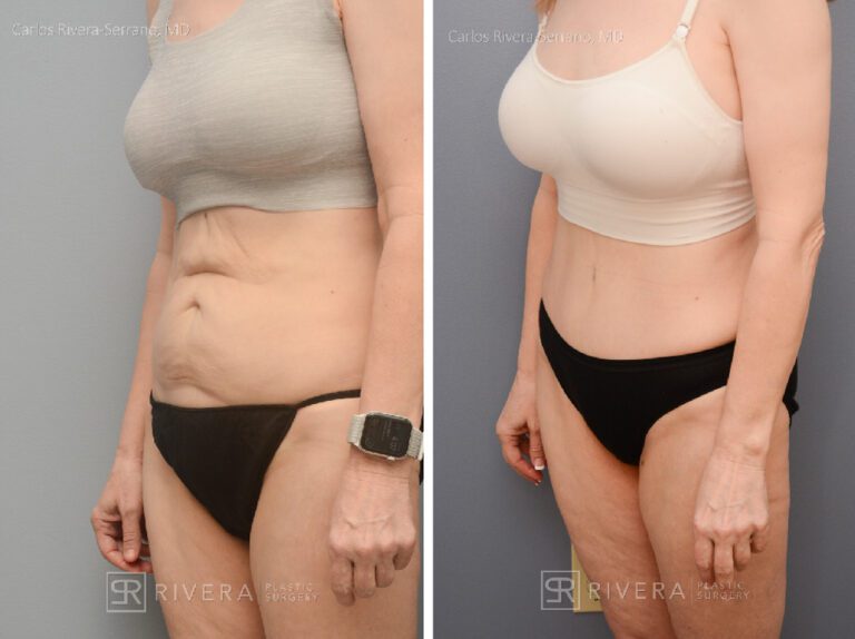 Abdominoplasty & liposuction in female patient - Tummy tuck lipoabdominoplasty - before and after case 5 - left lateral view