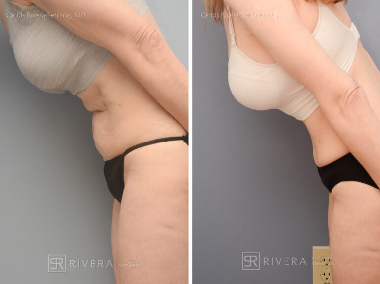 Abdominoplasty & liposuction in female patient - Tummy tuck lipoabdominoplasty - before and after case 5 - left lateral view