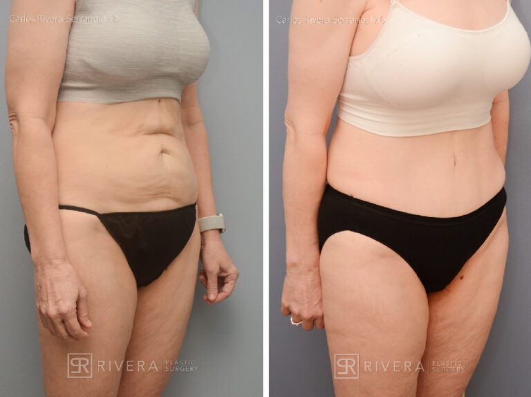 Abdominoplasty & liposuction in female patient - Tummy tuck lipoabdominoplasty - before and after case 5 - right lateral view