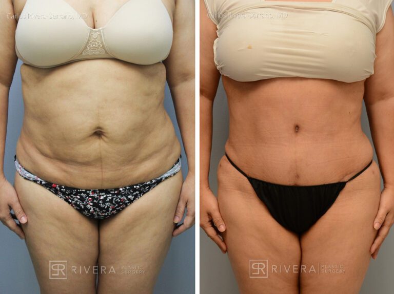 Abdominoplasty & liposuction in female patient - Tummy tuck lipoabdominoplasty - before and after case 6 - frontal view