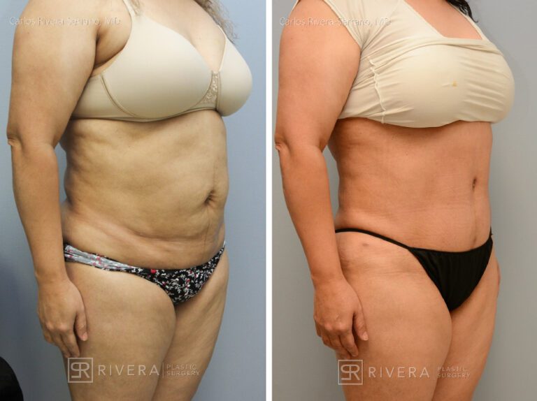 Abdominoplasty & liposuction in female patient - Tummy tuck lipoabdominoplasty - before and after case 6 - right lateral view