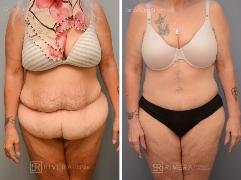 Abdominoplasty & liposuction in female patient - Tummy tuck lipoabdominoplasty - before and after case 8 - frontal view