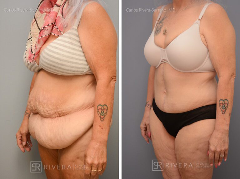Abdominoplasty & liposuction in female patient - Tummy tuck lipoabdominoplasty - before and after case 8 - left lateral view