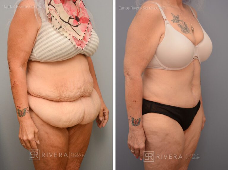 Abdominoplasty & liposuction in female patient - Tummy tuck lipoabdominoplasty - before and after case 8 - right lateral view