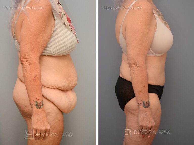 Abdominoplasty & liposuction in female patient - Tummy tuck lipoabdominoplasty - before and after case 8 - right lateral view