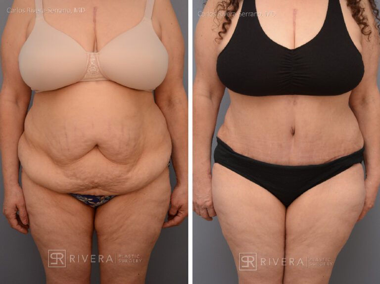 Abdominoplasty & liposuction for female - Tummy tuck lipoabdominoplasty - before and after case 9 - frontal view