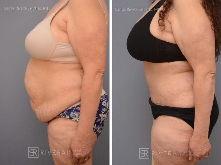 Abdominoplasty & liposuction for female - Tummy tuck lipoabdominoplasty - before and after case 9 - left lateral view