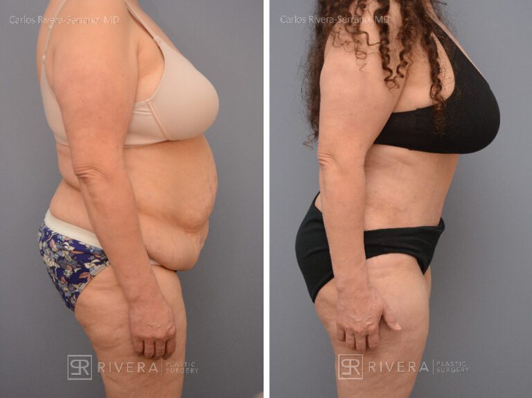 Abdominoplasty & liposuction for female - Tummy tuck lipoabdominoplasty - before and after case 9 - right lateral view