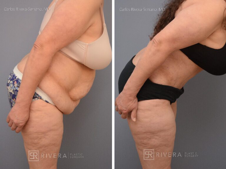 Abdominoplasty & liposuction for female - Tummy tuck lipoabdominoplasty - before and after case 9 - right lateral view